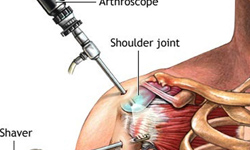 Артроскопия (плеча) плечевого сустава