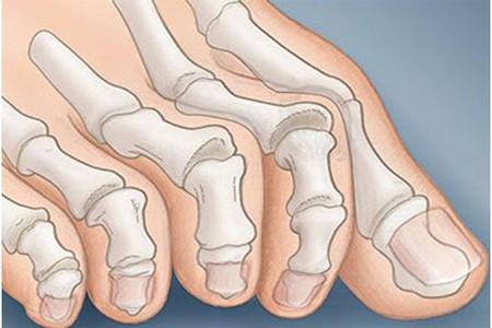 деформация пальцев стопы